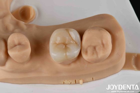 Buy High Strength Zirconia Dental Inlays And Onlays For Tooth Restoration online manufacture