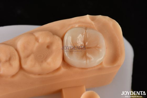 Buy 0.5mm-2mm Precise Fit Emax Dental Inlay Onlay For Reliable Tooth Restoration online manufacture