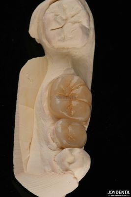 Buy Emax Dental Inlays And Onlays Fracture Resistant 1.5mm Low Translucency online manufacture