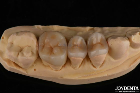 Buy Natural Looking Emax Inlay Onlay Long Lasting Dental Restoration 0.5mm 1mm 1.5mm Thick online manufacture