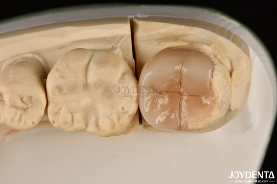 Buy Easy Clean Emax Inlays And Onlays Hypoallergenic Biocompatible Dental Restorations online manufacture