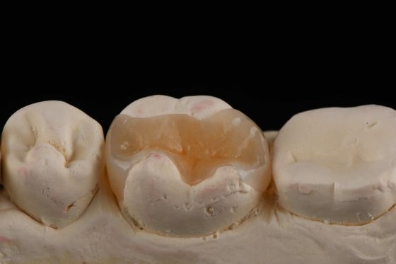 Buy E Max Material Inlay And Onlay In Dentistry Aesthetic Restoration Long Lasting online manufacture