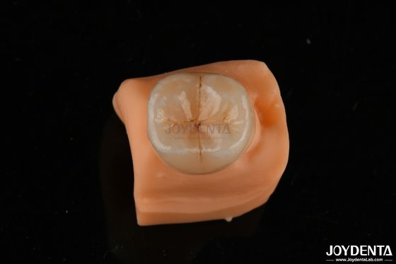Buy 0.5mm Stain Resistant Emax Inlay Onlay Accurate Fit For Dental Restorations online manufacture