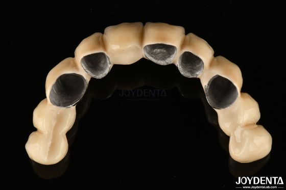 Buy PFM Ceramic Fused To Metal Crown High Biocompatible and Corrosion Resistant online manufacture