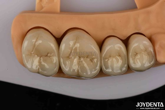 Buy Premium Gold and Palladium Alloy Dental Crowns for Enhanced Durability online manufacture