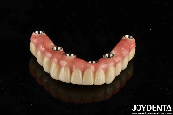 Buy Dental Titanium Malo Implant Bridge Combining Traditional And Modern Techniques online manufacture