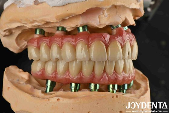 Buy Hybrid Technology Titanium Malong Dental Bridge Adjustable For Aesthetic Results online manufacture