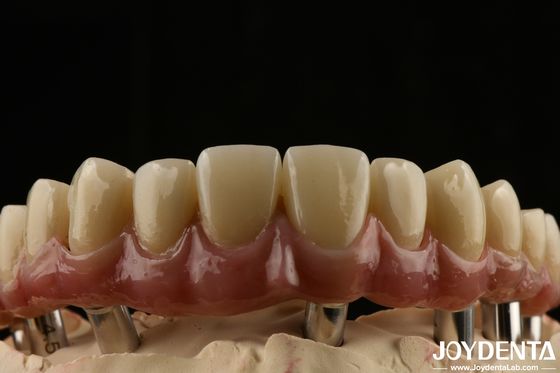 Buy Titanium Malong Dental Hybrid Bridge Long Lasting Adjusted Fit Low Density online manufacture