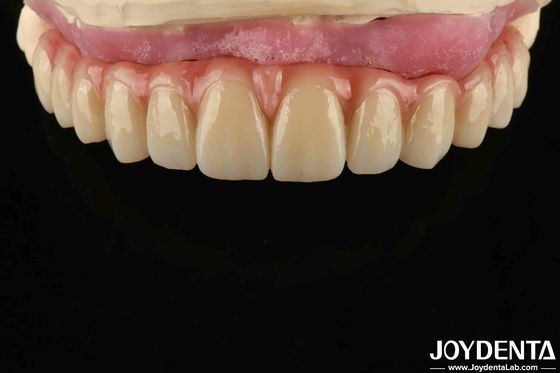 Buy Comfortable Wear Titanium Malong Hybrid Bridge Dental Adjustable Design Light Weight online manufacture