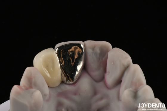 Buy Metallic Dental Maryland Bridge Good Chewing Function For Long Lasting Remediation online manufacture