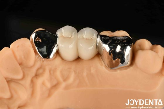 Buy Metallic Dental Maryland Bonded Bridge Good Remediation For Oral Clinical Repair online manufacture
