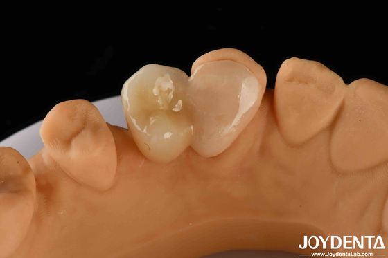Buy Emax Maryland Veneer Clinical Bonding Adhesion For Color Matching Dental Repair online manufacture