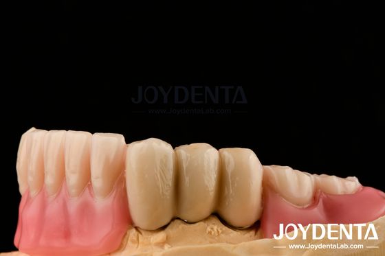 Buy Stainless Steel Prostheses Partial Dentures Attachments Polished Surface Ball Attachments online manufacture