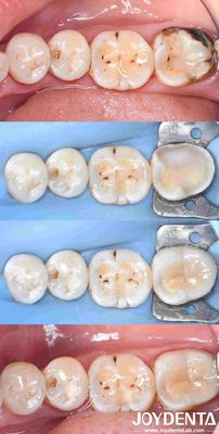 Buy Customizable Dental Porcelain Inlay Restoration For Perfectly Fitted Teeth Repair online manufacture