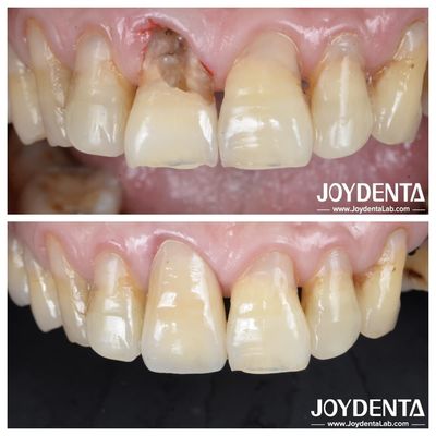 Buy Smooth Surface Dental Tooth Zirconia Crown For Posterior And Anterior Restorations online manufacture