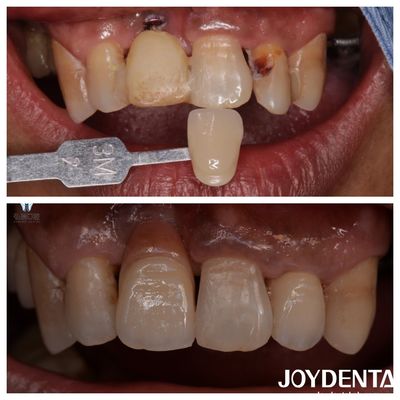 Buy Customized Dental Zirconia Veneers Natural Color Lifelike Restorations Tooth Appearance online manufacture