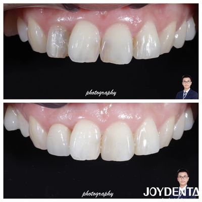 Buy Aesthetics Translucency Zirconia Crowns Natural Looking High Fracture Resistance online manufacture