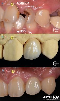 Buy Lifelike Tooth Appearance Zirconia Bridges Dental Restoration Wear Resistant Customized online manufacture
