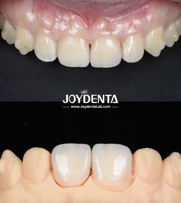 Buy Lightweight Smooth Surface Zirconia Dental Bridges For Implant Supported Restorations online manufacture