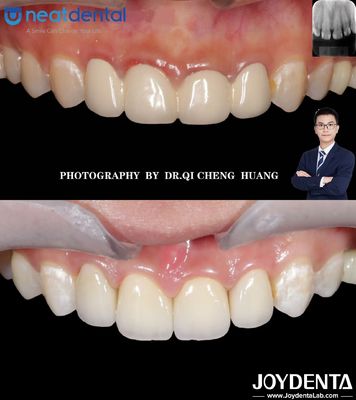 Buy High Translucency Multilayer Zirconia Crown For Anterior Posterior Teeth Crack Resistant online manufacture