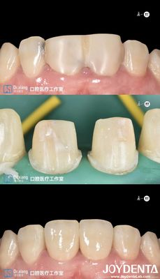 Buy Perfectly Fit teeth Zirconia Dental Crowns With CAD CAM Systems For Precision Manufacturing online manufacture