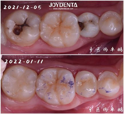 Buy High Durability Inlay Dental Restoration For Damaged Tooth Various Sizes Available online manufacture