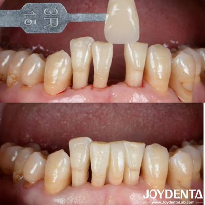 Buy Natural Shape Ceramic Maryland Bonded Bridge Dental Restorations Excellent Aesthetics online manufacture