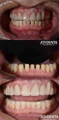 Buy Nature Shape Cosmetic Dentistry Porcelain Veneers , Dental Cosmetic Porcelain Veneers online manufacture