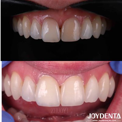 Buy Smooth Surface Dental Veneers For Crooked Teeth , Custom Cosmetic Porcelain Veneers online manufacture