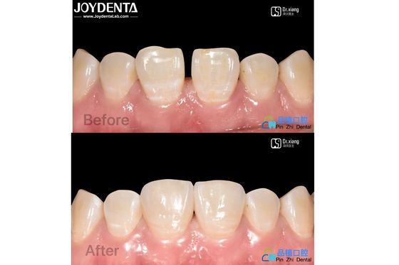 Buy Secure Fit Porcelain Veneers Dental Treatment Composite Resin Veneers Stain Resistant online manufacture