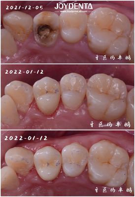 Buy Accurate Fit Dental Porcelain Inlay Damaged Teeth Restoration For Adults And Children online manufacture