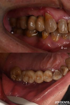 Buy Rough Surface Design Dental Implant for Subcrestal Bone Level Titanium Material online manufacture