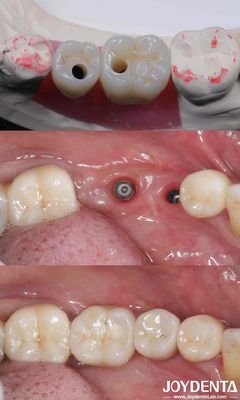Buy Cylindrical All On 4 Titanium Dental Implants 10-16mm Length Hex Connection online manufacture