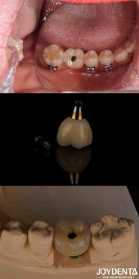 Buy 4-6 Dental Endosseous Tapered Implant Subcrestal Bone Level And Internal Hex Connection online manufacture