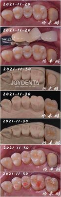 Buy Seamless Fit Porcelain Inlay Dental Procedure Customizable Shape For Teeth Repair online manufacture