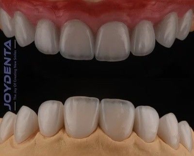 Buy High Translucency Feldspathic Veneer , Cosmetic Porcelain Veneers With Strong Adhesion online manufacture