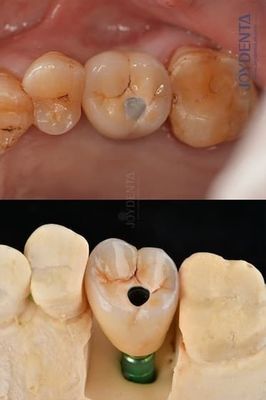 Buy Titanium Full Arch Dental Implants Prosthetic Platform 4.1mm For Exceptional Durability online manufacture