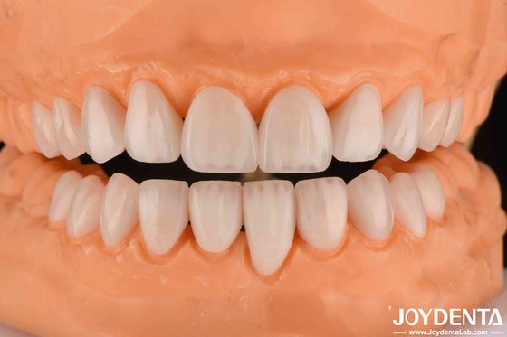 Buy Ceramic Emax Veneers 0.3-0.5mm Thickness Long Lasting Cosmetic Porcelain Veneers online manufacture