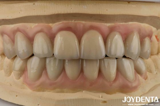 Buy High Translucency Emax Cosmetic Dentistry Veneers High Aesthetics Ultra Thin online manufacture