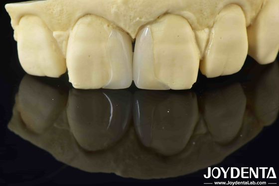 Buy Customizable Smooth Micro Thin Veneers Long Lasting Natural Looking Veneers online manufacture