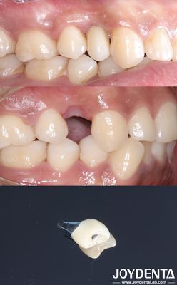 Buy All On 4 Dental Tooth Implant Cylindrical Shape Titan Implant Dental Rough Surface online manufacture