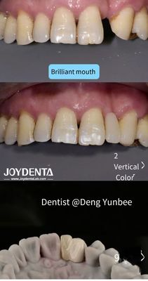 Buy Resin Bonded Maryland Bridge Posterior Teeth for Regular Brushing Flossing online manufacture