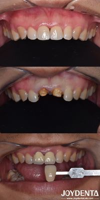 Buy Biologically Oriented Preparation Technique Dental vertical Preparation Minimally Invasive online manufacture