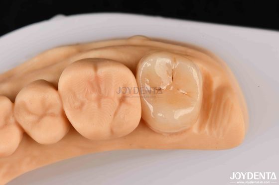 Buy High Strength Emax Inlay Onlay A2 Color Long Lasting For Damaged Teeth Restoration online manufacture