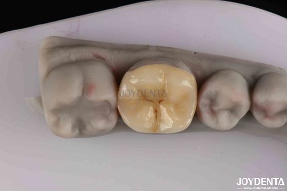 Buy Customizable Zirconia Inlay Onlay Minimal Preparation For Damaged Teeth Restoration online manufacture