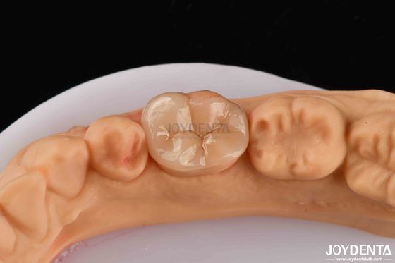 Buy High Durability Dental Inlay Onlay Composite Natural Looking Appearance online manufacture
