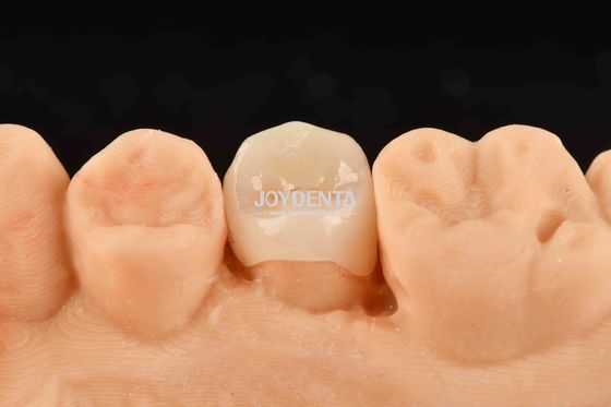 Buy Customizable White Composite Inlay Onlay Natural Looking Minimally Invasive Tooth Restoration online manufacture