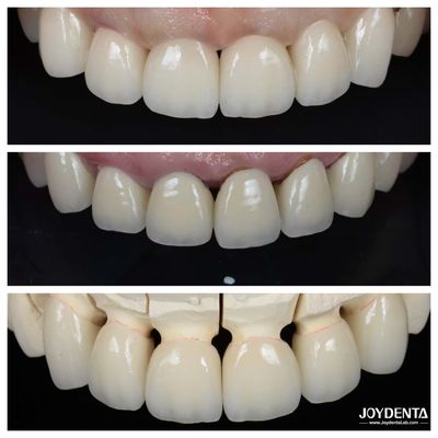 Buy Excellent Biocompatibility Dental Porcelain Veneers No Need For Preparation Process online manufacture