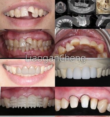 Buy Biocompatibility Safe Zirconia Dental Crowns For Long-term And Implant-supported Restorations online manufacture