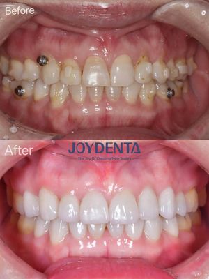 Buy Dental Veneers for Missing Teeth | Global Premium Dental Lab Services online manufacture